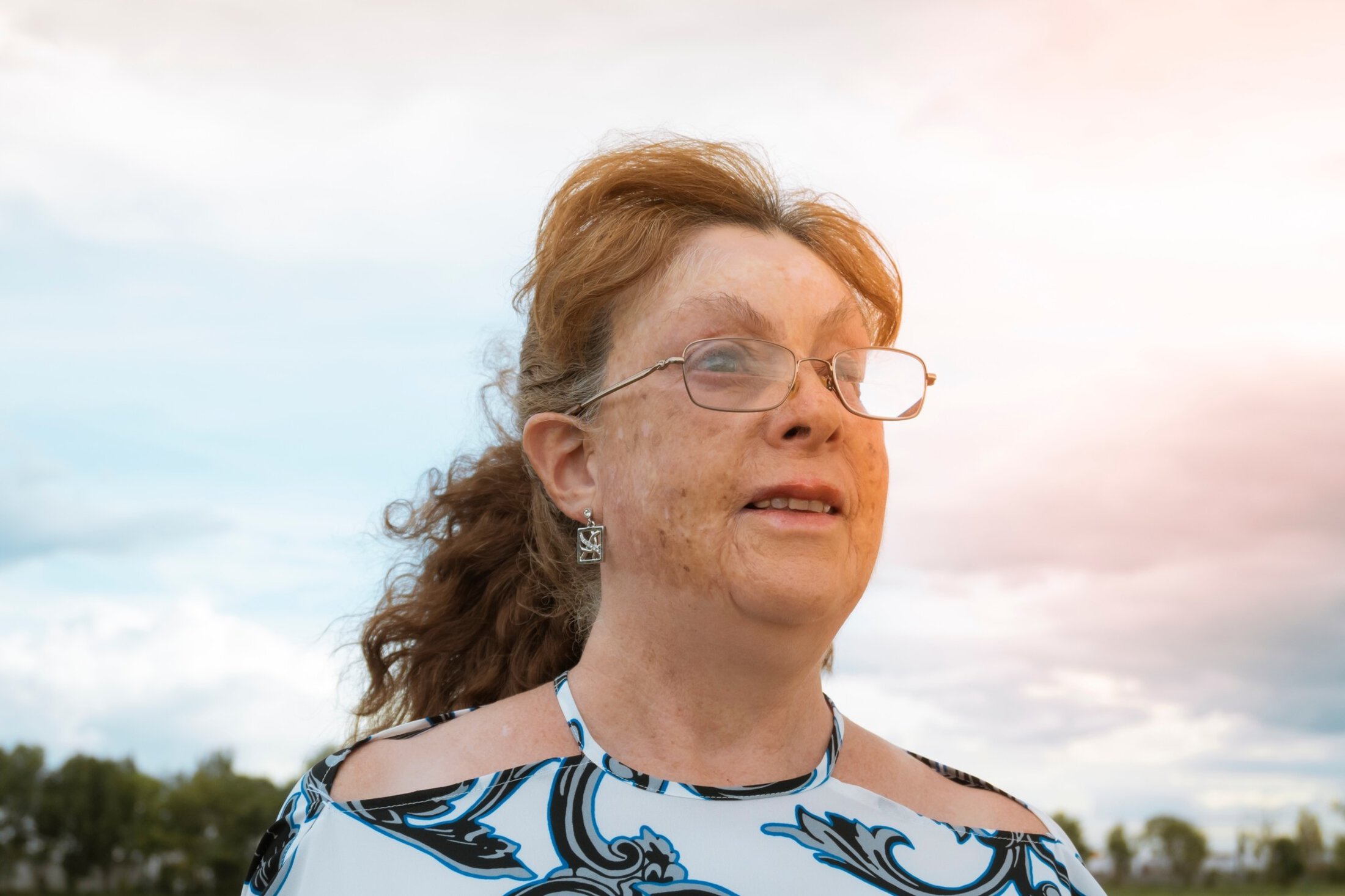 woman with burn scars smiles outdoors.