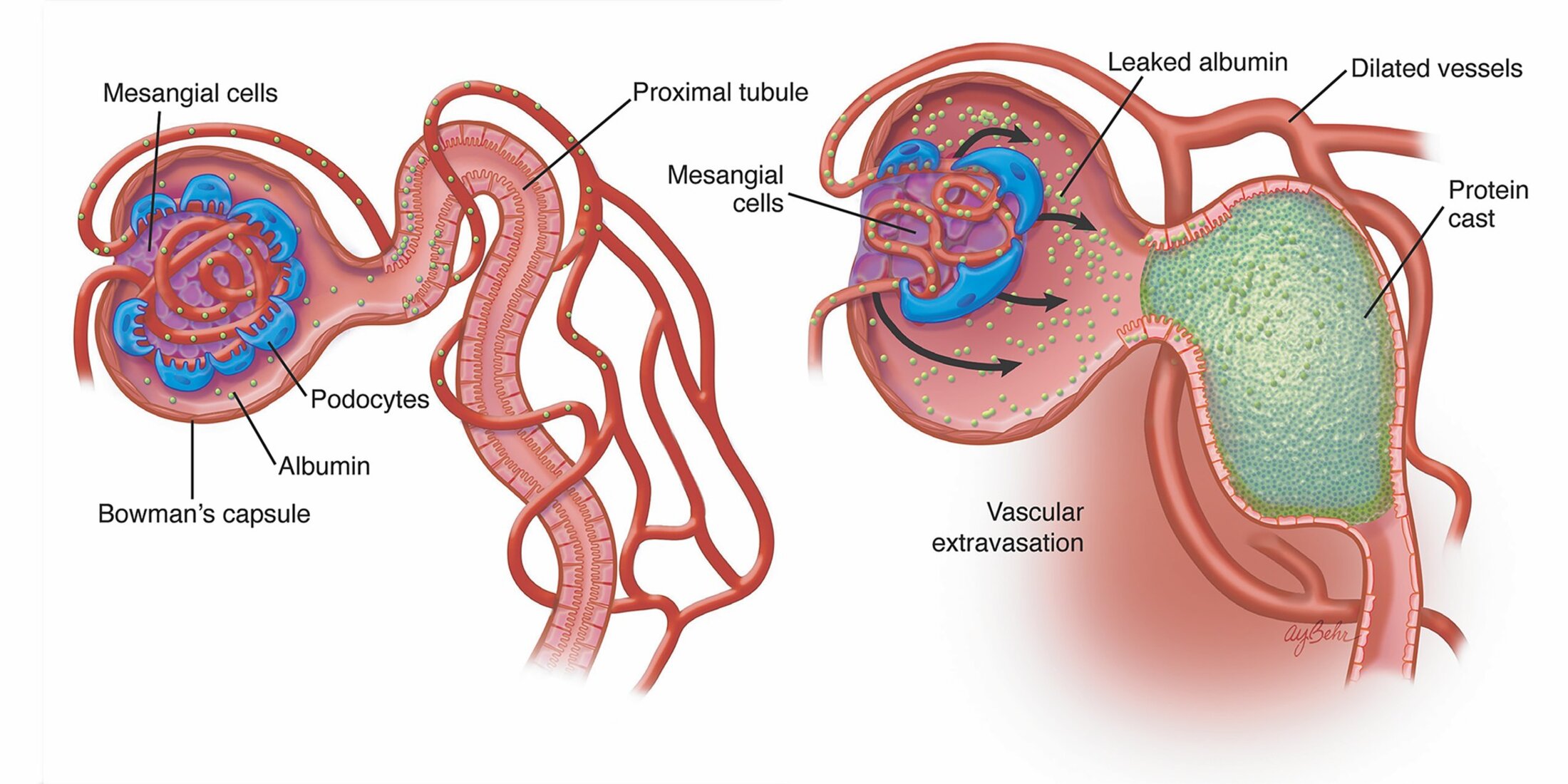 Medical illustration showing the first two steps in the development of albuminuria, glomerular pathology, and renovascular disease in salt-induced hypertension.