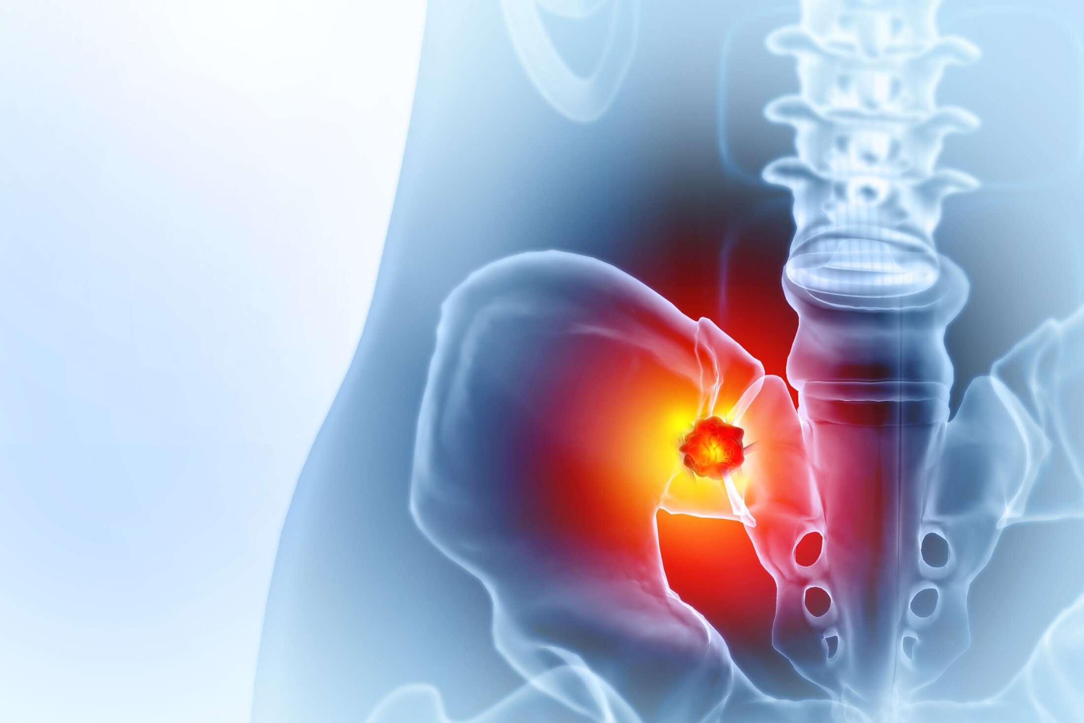 3D illustration of the pelvis and lower spine with a tumor in the hip bone radiating yellow and red colors