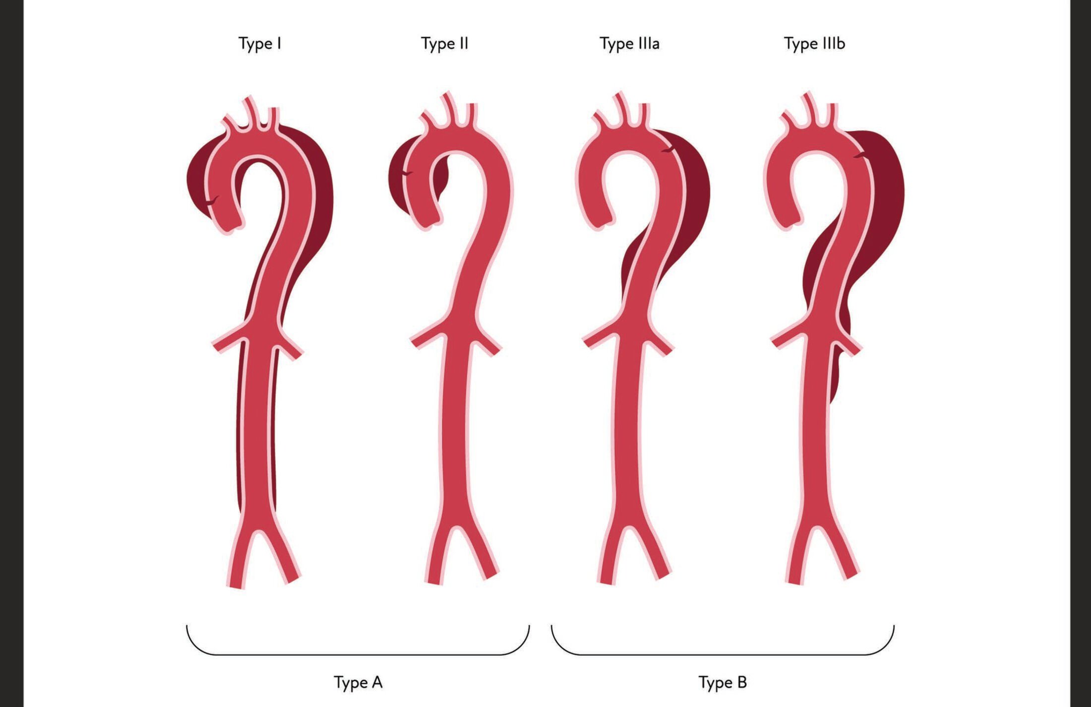 Four red figures shaped like backward candy canes with short legs on the bottom. They have what look like arms and three tubes sticking out of the tops. The words say Type 2, Type II, Type IIIa, Type IIIb. Below it says Type A and Type B.