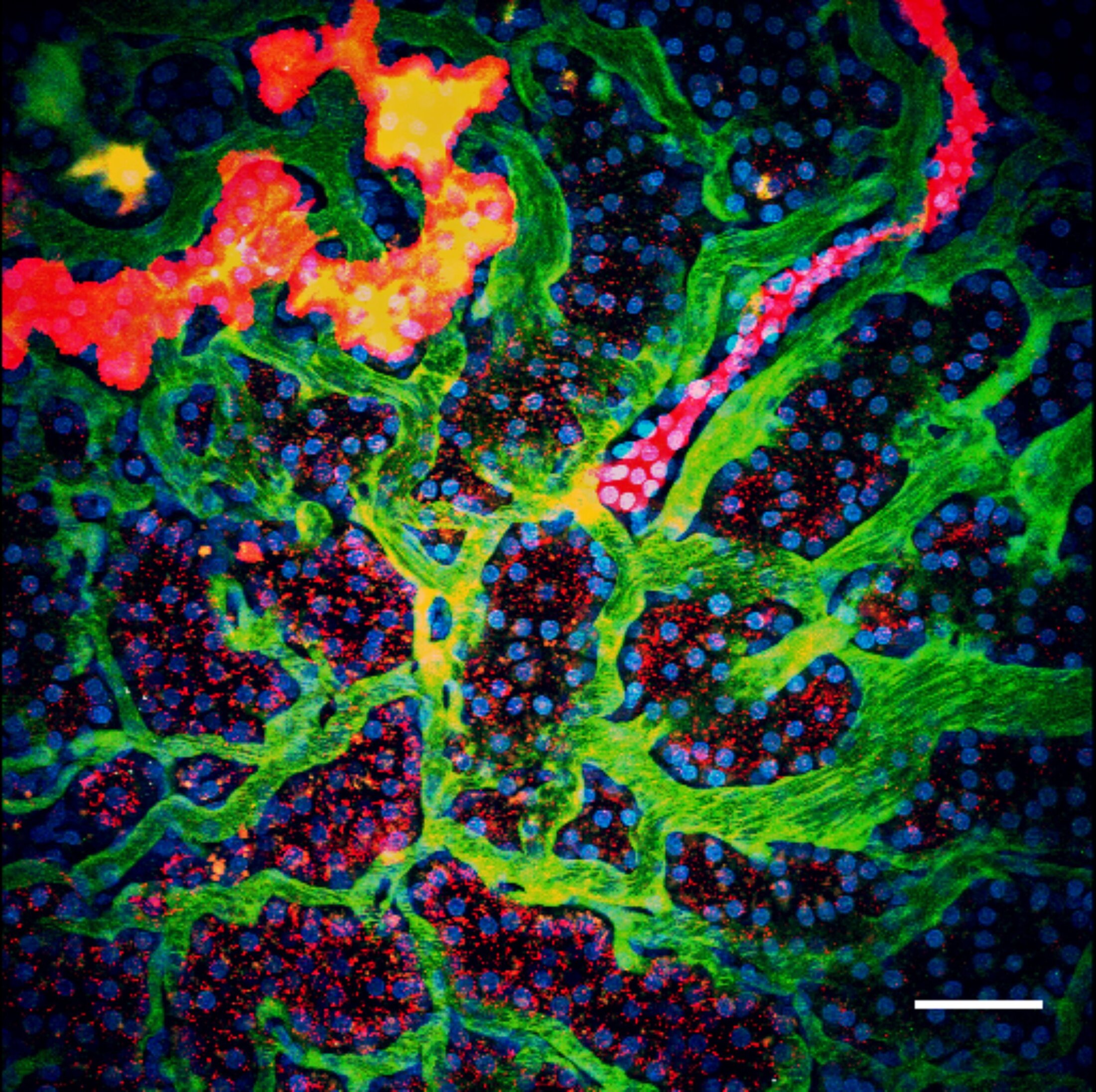 Medical illustration showing the third step in the development of albuminuria, glomerular pathology, and renovascular disease in salt-induced hypertension.