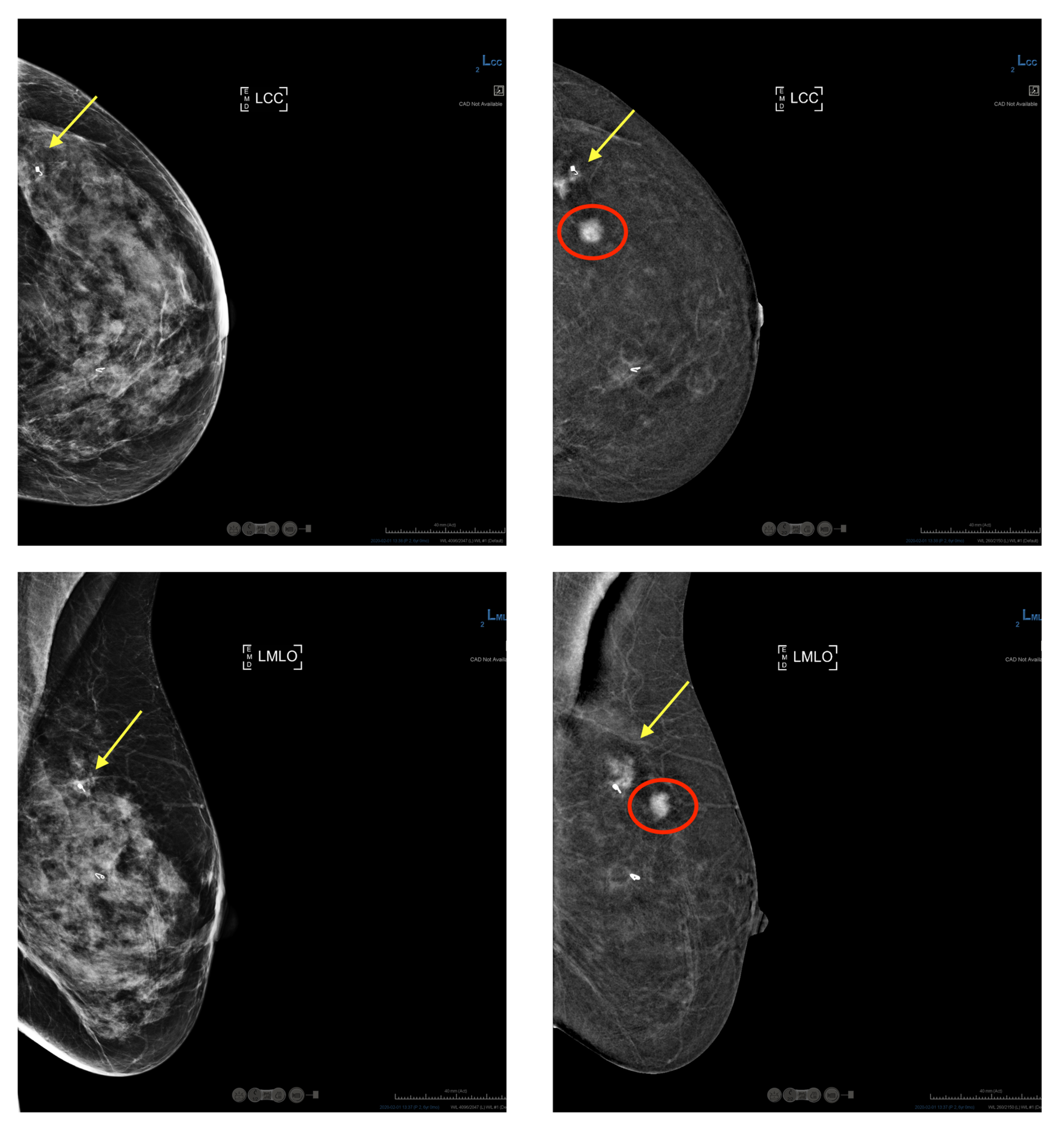 Scans showing what is visible via traditional mammogram versus contrast-enhanced mammogram.