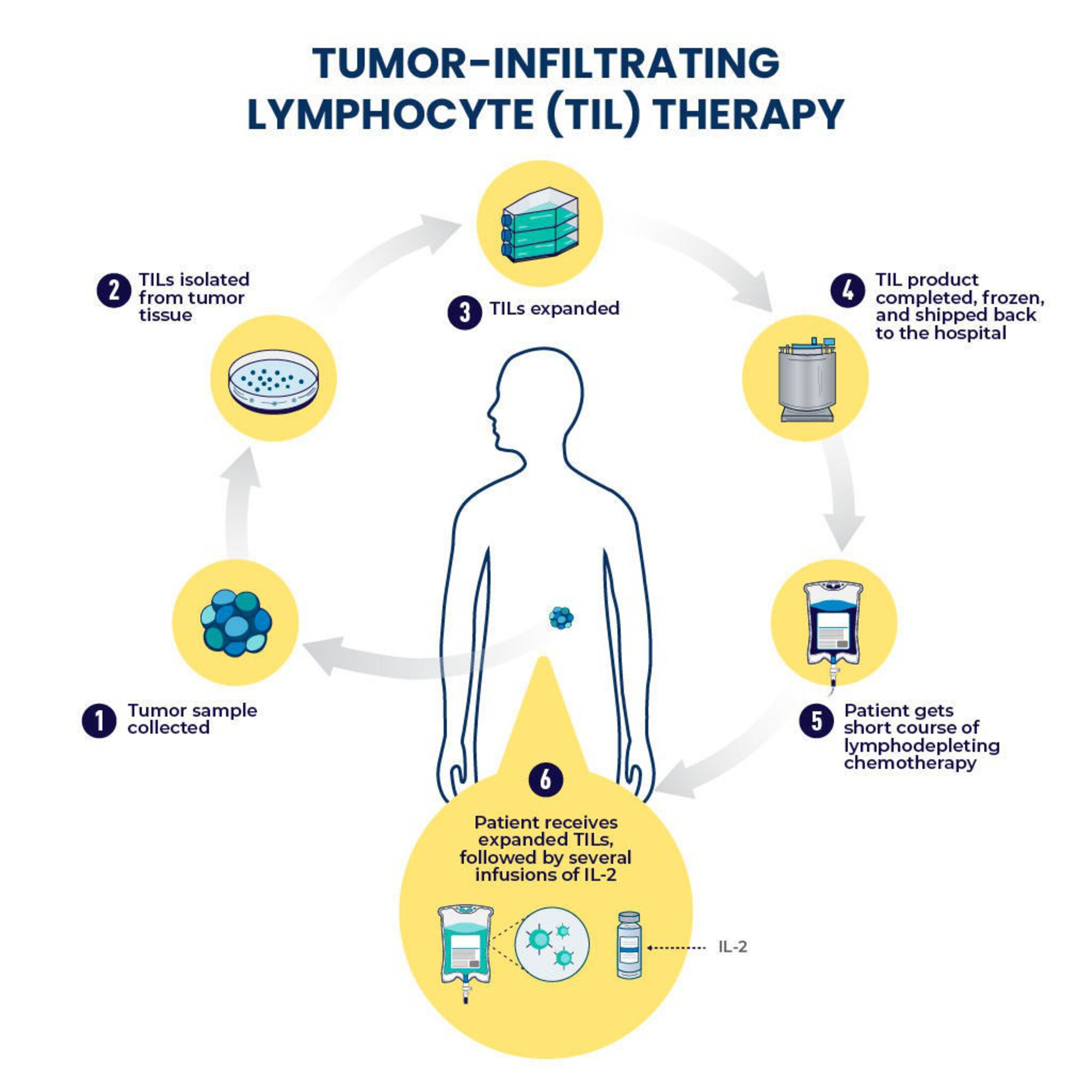 Illustration of the TIL therapy cycle from collecting a tumor sample to isolating TILs to expanding TILs to freezing the product and shipping back to hospital to giving patient short course of lymphodepleting chemotherapy to give the patient the expanded TILs followed by several infusions of IL-2.