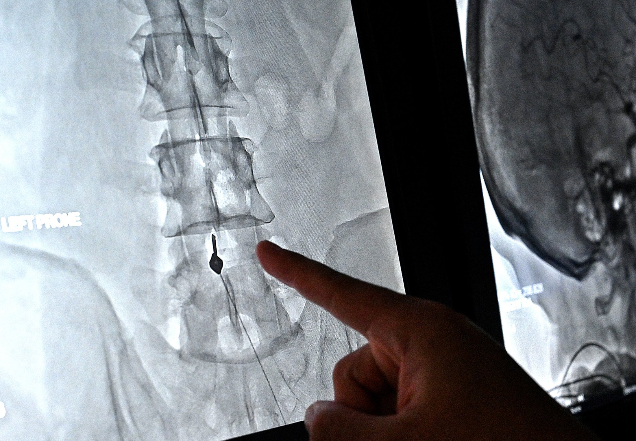 A finger points to an image of a spine. There is a small black object toward the bottom of the spine with a string trailing down to the bottom of the image.