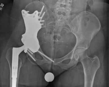 x-ray of pelvic reconstructive surgery