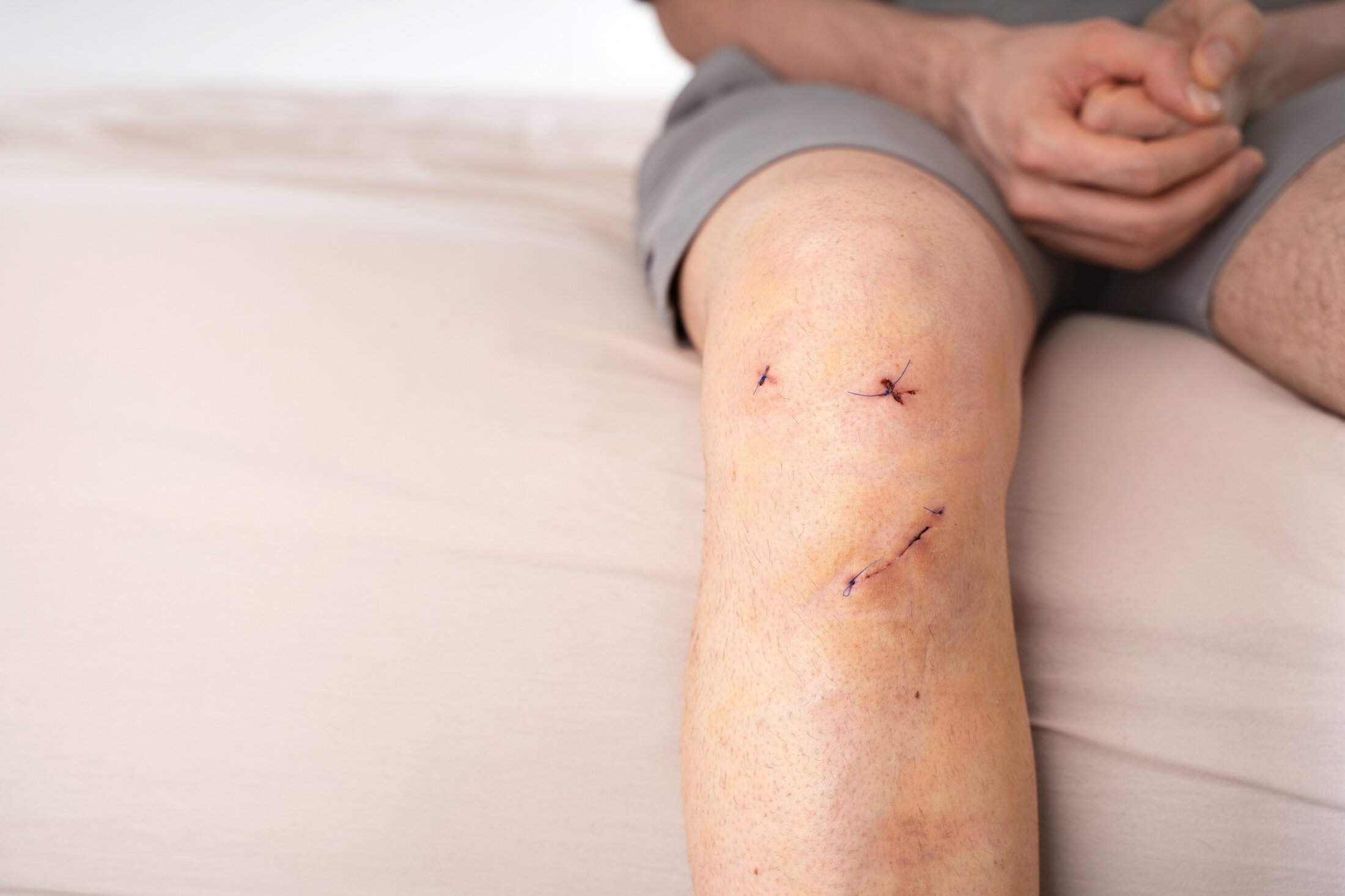 Male wound on knee with multiple post-surgical stitches after ACL reconstruction, sitting on light bedding. Concept of real healing, orthopedic recovery, cruciate ligament surgery. Copy space